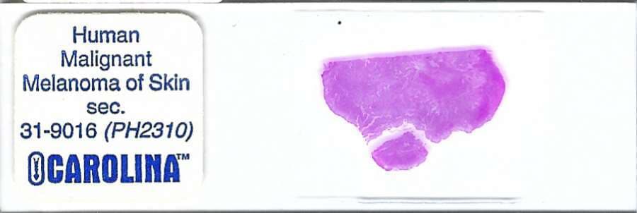 Human Malignant Melanoma of Skin Pathology Microscope Slide