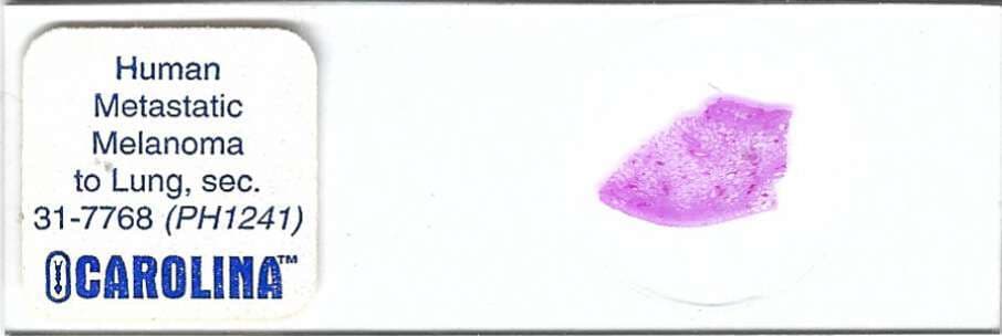 Human Metastatic Melanoma of Lung Pathology Microscope Slide