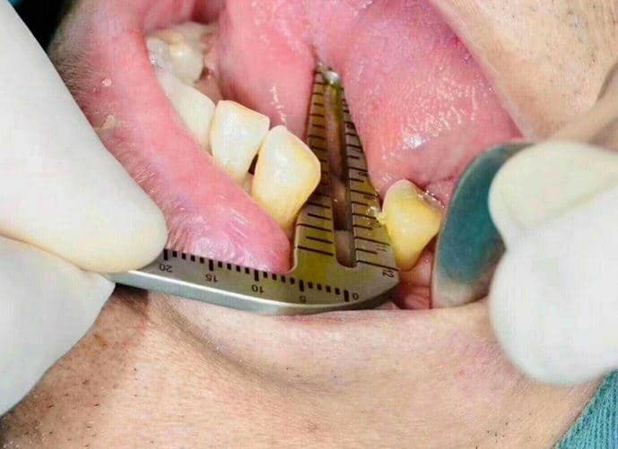 Dental Gauge Implant Surgical Drilling Guide Locator Parallel Depth Pin 3