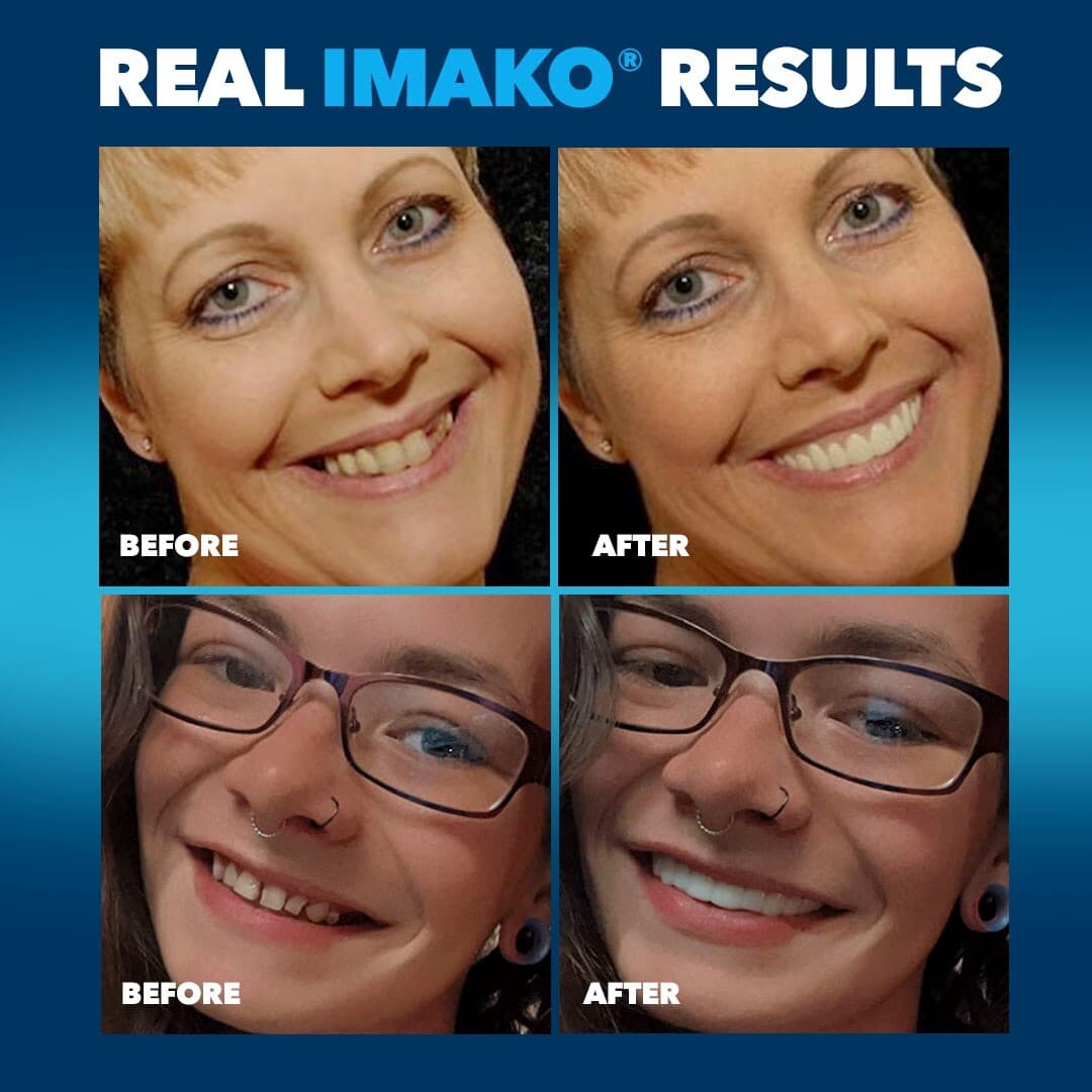 Imako® Premium Cosmetic Teeth 1PK - Large Natural -DIY Smile Makeover - USA Made 5