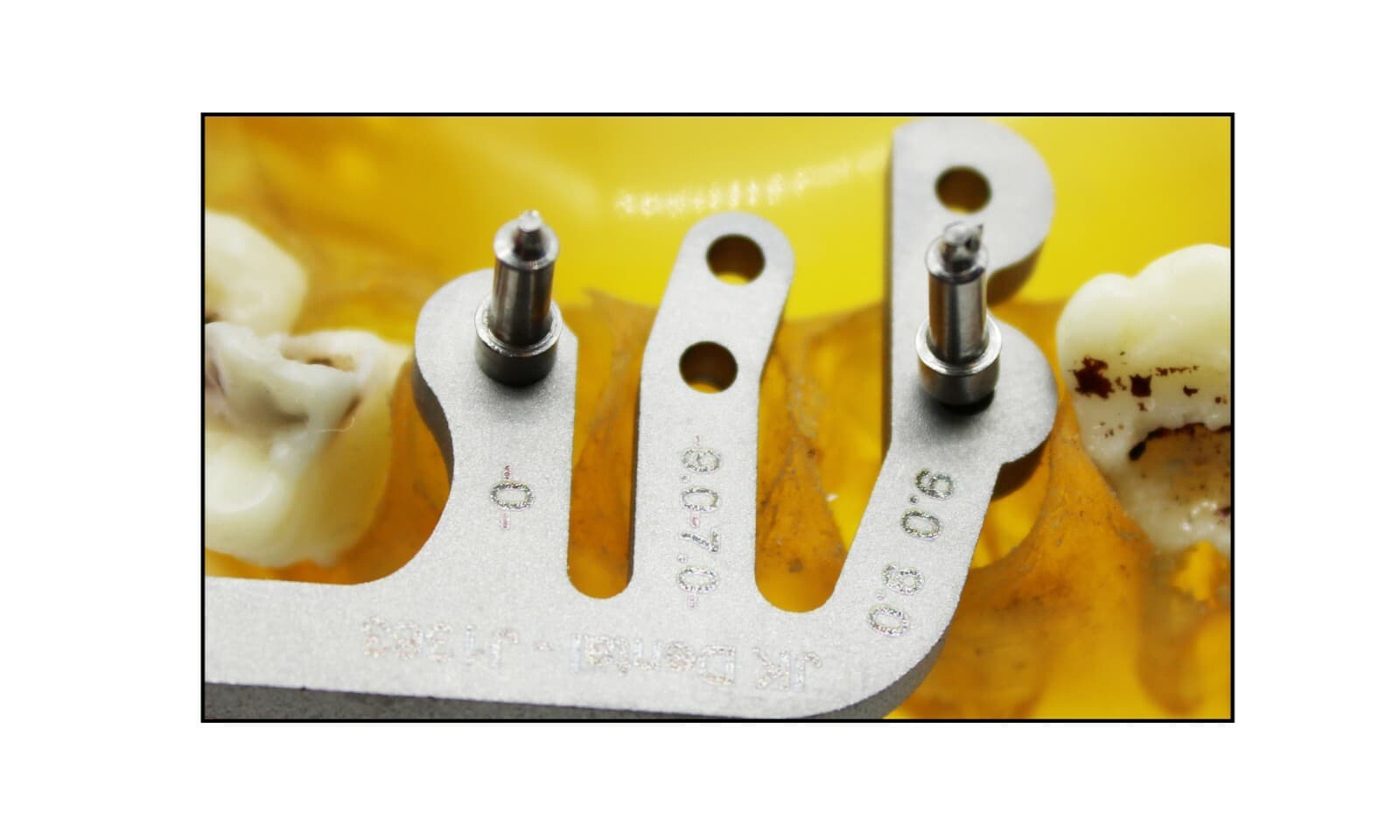 Dental Gauge Implant Surgical Drilling Guide Locator Parallel Depth Pin 4