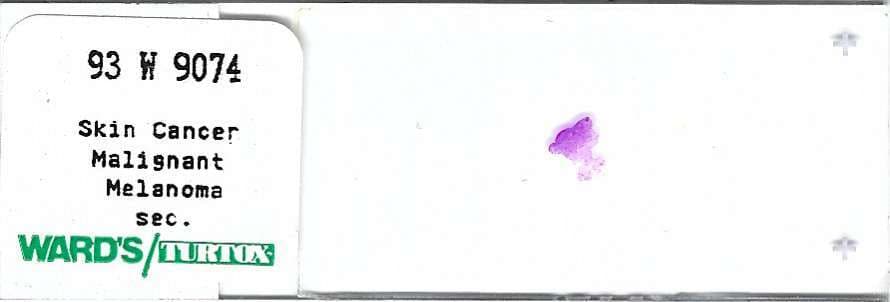 Human Malignant Melanoma Skin Cancer Pathology Microscope Slide