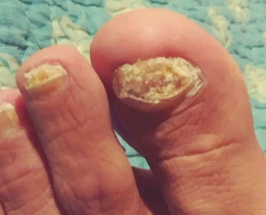 Hongo Get Out Fungus: 100% Garantizado  2