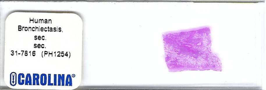Human Bronchiectasis Pathology Microscope Slide