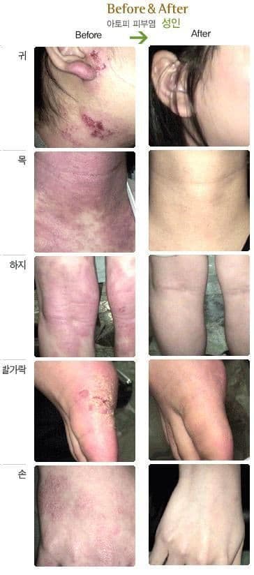 3 Lot of  ISAL Atopy Eczema Cream Lotion./Made in USA 2