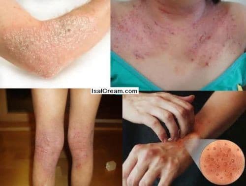 3 Lot of  ISAL Atopy Eczema Cream Lotion./Made in USA 3