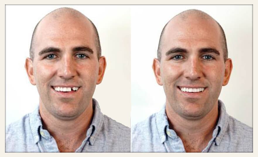 3 Pack Set Instant Smile  All Shades Temporary Teeth Replacement Kit  6