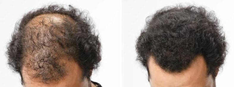 Hair Fibers For Xfusion Bottles -  Refill Bag FAST SHIP FROM USA 3