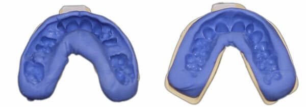 Custom Dental Retainers Upper AND Lower Set- Aligner Type Made by USA Dental Lab 5